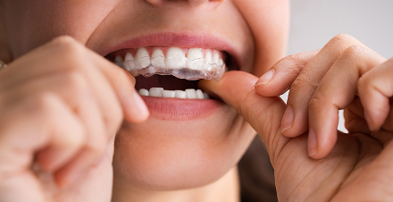 Free Invisalign Consultation