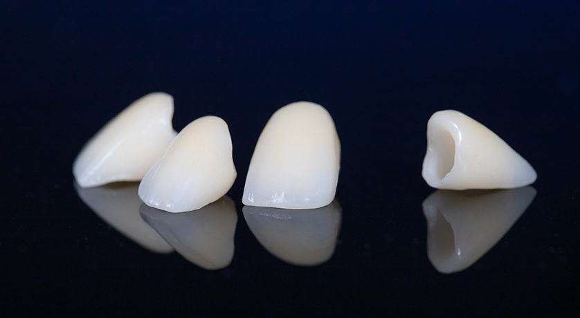 Why Porcelain Crowns Are a Top Choice for Repairing Damaged Teeth?