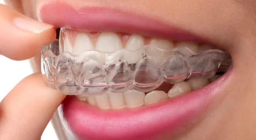 Clear invisialign aligners for teeth.